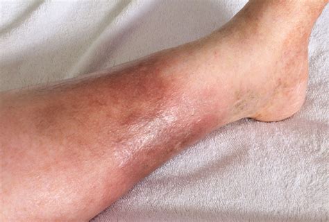 Why Are Varicose Veins Warm To The Touch at Deborah Talbot blog