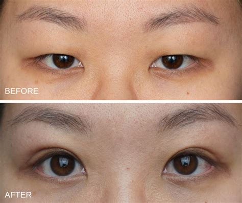 What's involved in Asian Blepharoplasty? - ASAPS