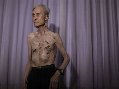 Nagasaki and Hiroshima anniversary: Powerful photos of survivor show effects of atomic bomb 70 ...