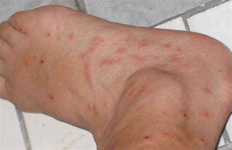 Cold weather rash or bed bug bites, what is the difference? - Bedbug Inspector : Canine Bed Bug ...