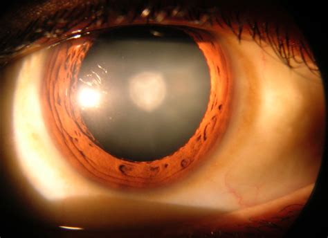 Cataract surgery - Wikipedia
