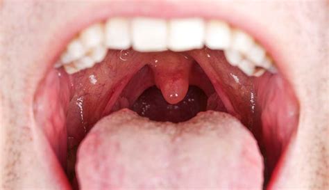 Normal Hard Palate