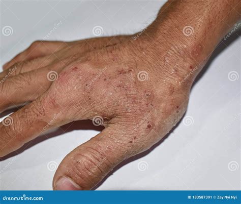 Ringworm Red Patches. Skin Infection Stock Image | CartoonDealer.com ...