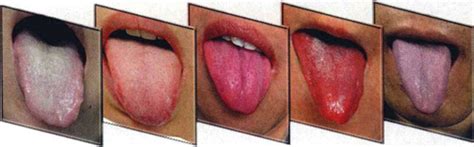 Tongue color in TCM tongue diagnosis