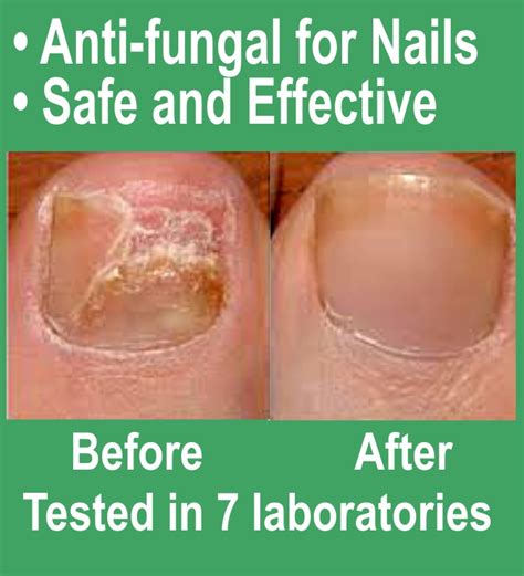 Nail Fungus before and after - Bettamed