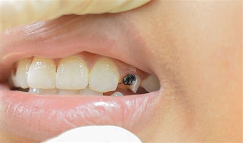 the effects health is far more dangerous teeth in Vietnam