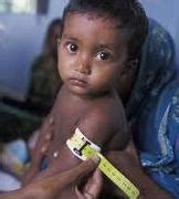 What is Malnutrition in Children? | Causes and Effects