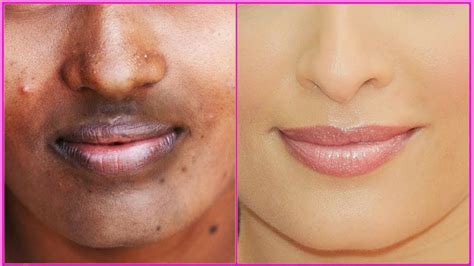 How To Remove Dark Black Patches, Dark Spots,Hyper Pigmentation Around Your Mouth | Uneven Skin ...