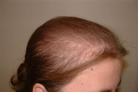 Case-7930 | Leonard Hair Transplant Associates