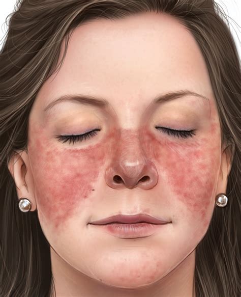 Can Lupus Cause Swollen Face - Diseases Club Center3