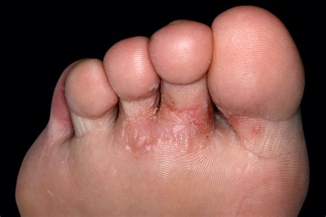 Itchy Blisters On My Foot Clearance | emergencydentistry.com