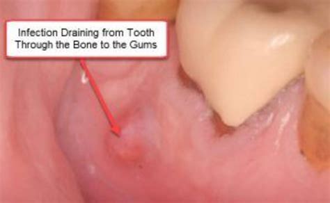 Root Canal Infection Symptoms