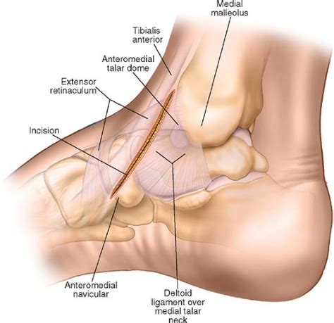 Anteromedial Approach to the Talar Neck | Musculoskeletal Key