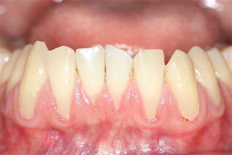 Can Receding Gums Be Reversed?