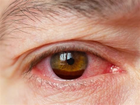 Hyphema (Bleeding in Eye): Diagnosis, Symptoms & Causes