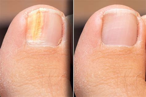 Laser Nail Fungus Treatment | NY | Hudson Dermatology