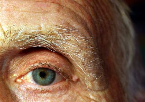 Gross Eye Diseases