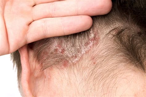 Everything You Need To Know About Seborrheic Dermatitis — Kapyderm USA