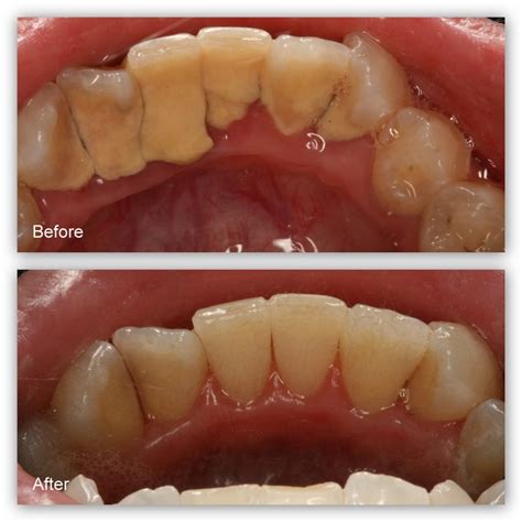 How To Remove Black Tartar From Teeth : Clinically proven results ...