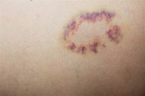 Bruise Purple Hemorrhage Contusion Stock Photos, Pictures & Royalty-Free Images - iStock