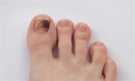 Melanoma under toenail pictures: black spot, nail melanoma pictures ...