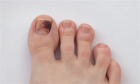 Melanoma under toenail pictures: black spot, nail melanoma pictures, toenail melanoma pictures ...