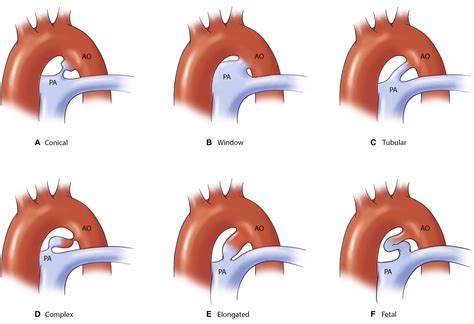 Patent Ductus Arteriosus: A Contemporary Perspective for the Pediatric ...