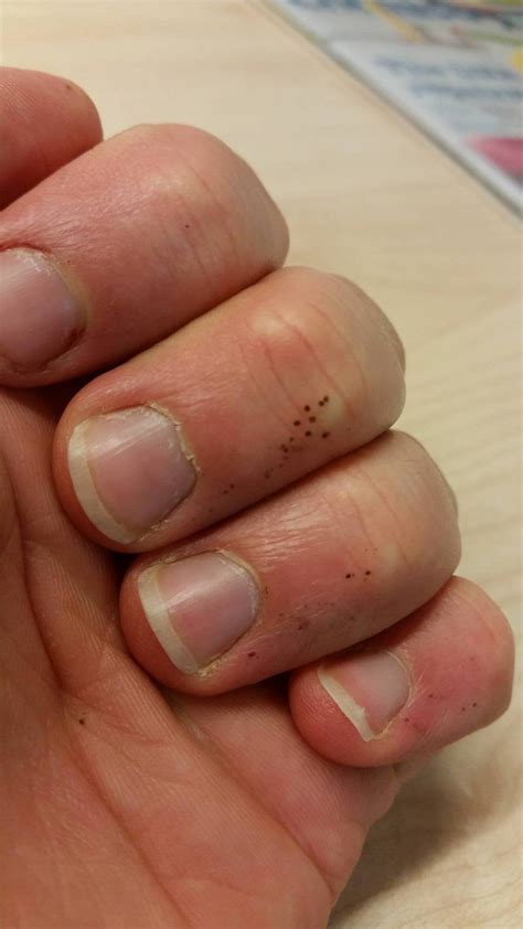 What Do Little White Dots On Your Fingernails Mean - Design Talk