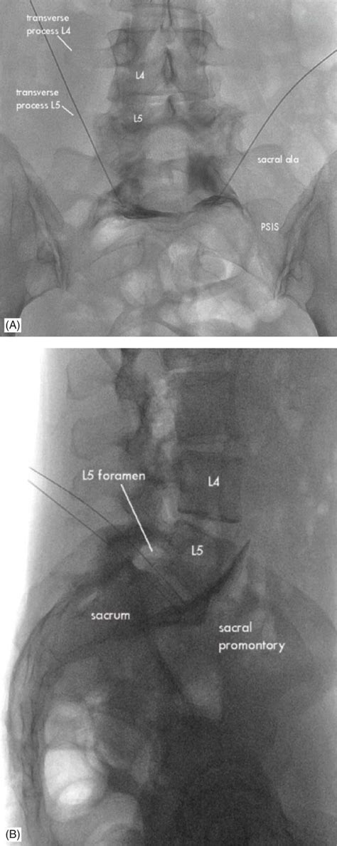 Superior and Inferior Hypogastric Plexus Blocks | Anesthesia Key