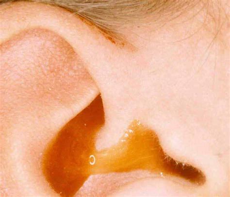 Fluid Draining from the Ear: Types, Causes, and Treatment