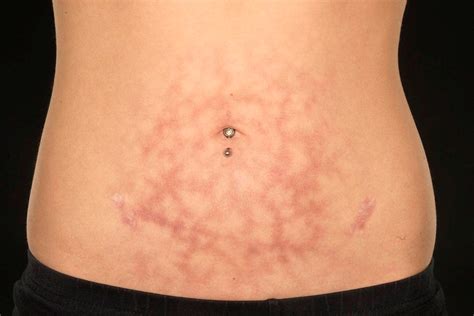 A reticulated eruption on the lower abdomen in a 17 year old girl | The BMJ