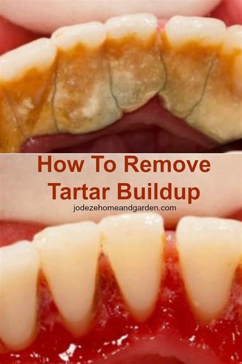 How To Remove Tartar From Teeth Diy - HOWTOREMVO