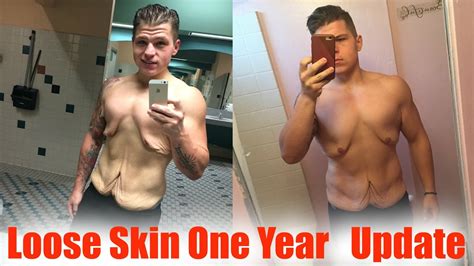 Loose Skin Progress (One Year) 170 Pound Weight Loss - YouTube