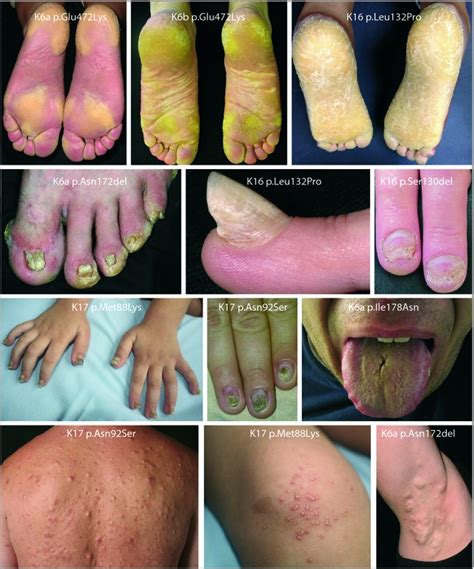 Clinical features of pachyonychia congenita (PC). Palmoplantar... | Download Scientific Diagram