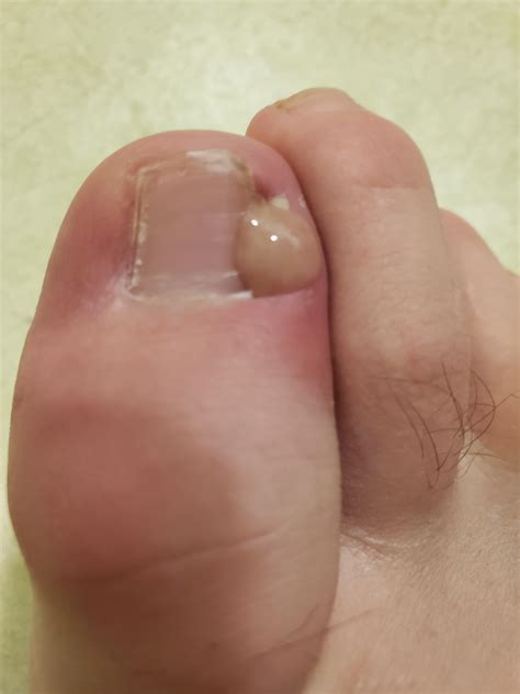 Ingrown toenail infection pop : r/popping