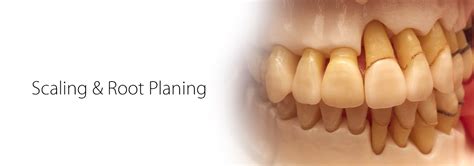 Scaling & Root Planing - Kians Dental Studio