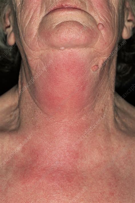 Angioedema - Stock Image - M320/0398 - Science Photo Library