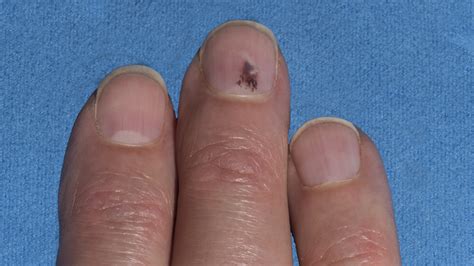 What Causes Red Fingernail Beds - Design Talk