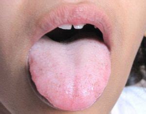 8 Great Home Remedies For Coated Tongue - Home Remedies For All Kinds Of Ailments | Top 8 Home ...