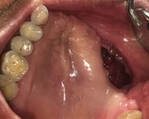 New artificial, fixed teeth and jaw after treatment of Black fungus (mucormycosis) of jaw at ...