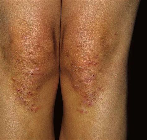 List 97+ Pictures Pictures Of Dermatitis On The Back Latest