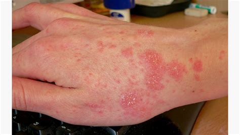 what is the fastest way to kill scabies