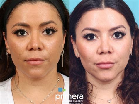 Buccal Fat Removal Before and After Photo Gallery | Orlando, Florida ...