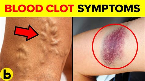 7 SILENT Blood Clot Symptoms You Must NOT Overlook! - YouTube