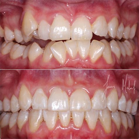 Crooked teeth explore your options for straightening your teeth here ...