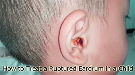 How to Treat a Ruptured Eardrum in a Child