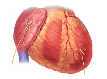 Pacing Wires - Zimmer Biomet