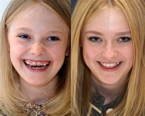 Dakota Fanning Teeth