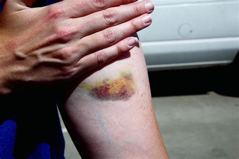 Unexplained bruises: causes, treatment and prevention – Mitch's Pool Service