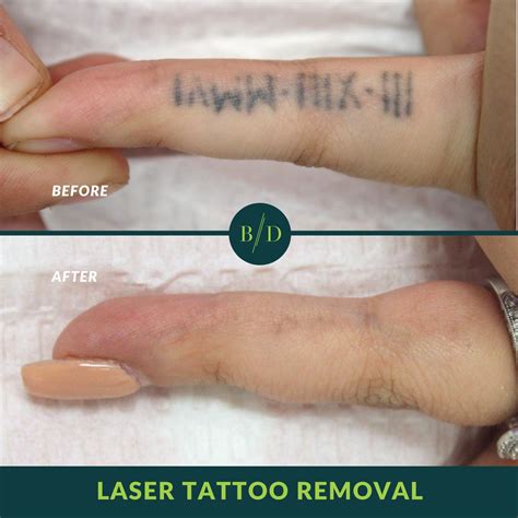 surgical tattoo removal before and after - Kazuko Gilliland